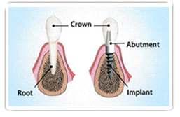 Circumstances where implants may not be suitable, or situations that have an increased risk of implant failure, include: Heavy smoking this slows down and hinders the healing process.