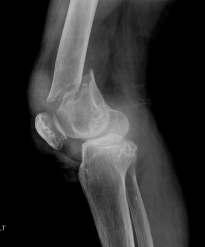 슬관절치환술은손상된뼈및연골을 인공관절로대체시켜주는시술입니다. 수술시전신마취또는척추마취를해야합니다. 절개는앞무릎의 8 인치(19.2 cm) 에걸쳐이루어집니다. 넓적다리뼈하단부위와정강이뼈위쪽끝의하단의손상된표면을제거하고, 인공관절로대체하게됩니다. 인공관절은금속, 세라믹및플라스틱으로 이루어집니다.