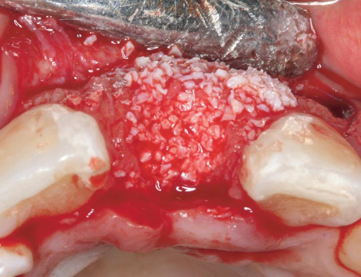 (A) Labial view after implant