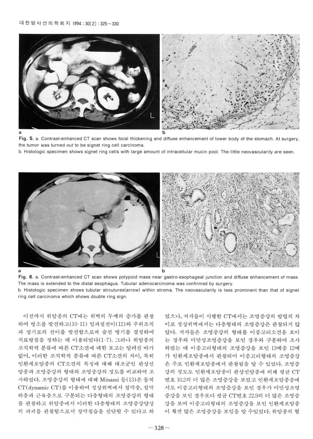 대한방사선의학회지 1994; 30(2) : 325-330 Fig. 5.. Contrst-enhnced CT scn shows locl thickening nd diffuse enhncement 01 lower ody 01 the stomch.