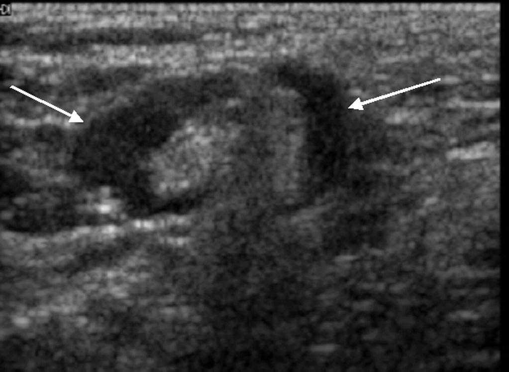유방에 실리콘 삽입물을 시술 받은 환자에 서 삽입물이 파열되거나 현미경학적 실리콘 유출이 있을 경우 액와부 림프절 종대가 생길 수 있고 이 경우는 림프절이 다른 림프절 종대의 경우보다 매우 고밀도로 보여 감별이 된다 [7]. Fig. 3. Normal axillary lymph node.