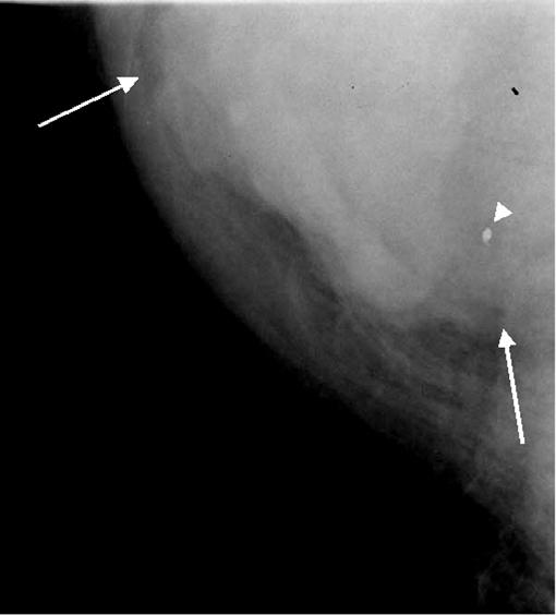 Fig. 10. 31-year-old woman with cavernous hemangioma in the right axilla.