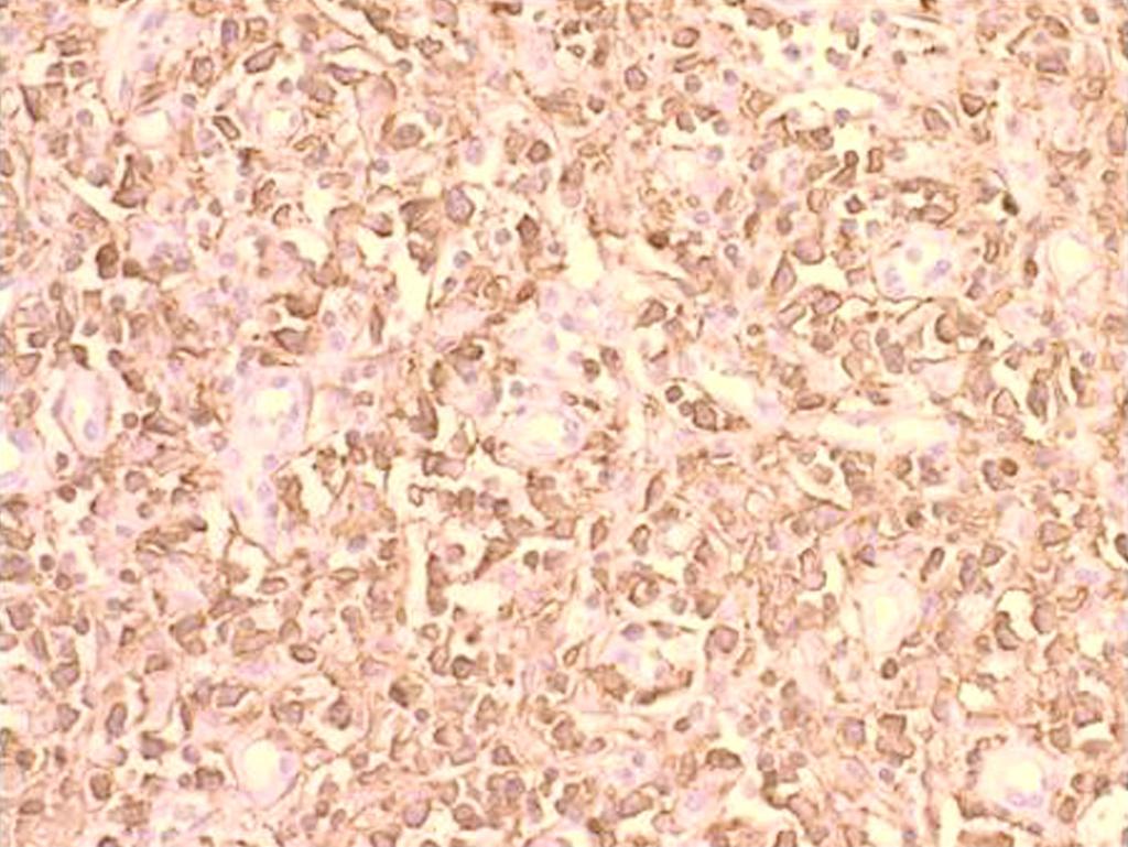 the diffuse large -cell type (H & E, original magnification 400). () Tumor cells are im munopositive for bcl20 (Immunohistochemistry bcl 20 200).