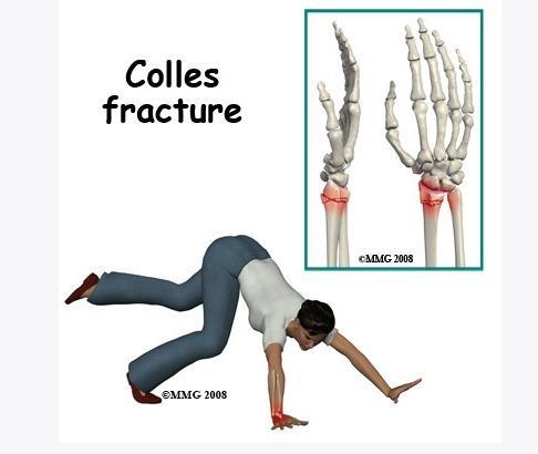 2) 수근부골절의종류 (1) Colles 골절 1정의 : 요골골간단의골절, 요수근관절면으로부터 1.