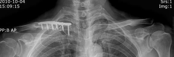 6. 쇄골의골절 합병증 : 쇄골하동맥및상완신경총손상, 불유합, 견봉쇄골관절탈구, 외과성관절염, 가골과형성발생