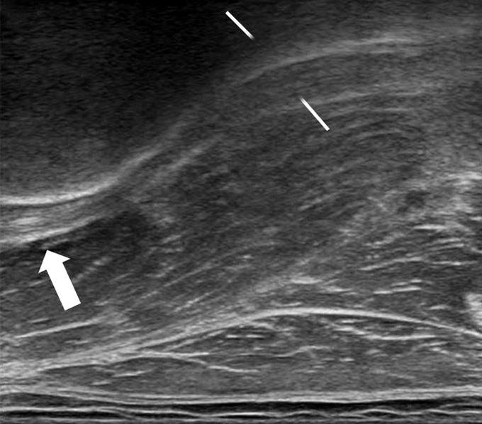 Sagittal plane ultrasonography of the anterior hip joint shows intact hyperechoic triangular labrum (arrow). IP, iliopsoas; Ac, acetabulum; FH, femoral head.