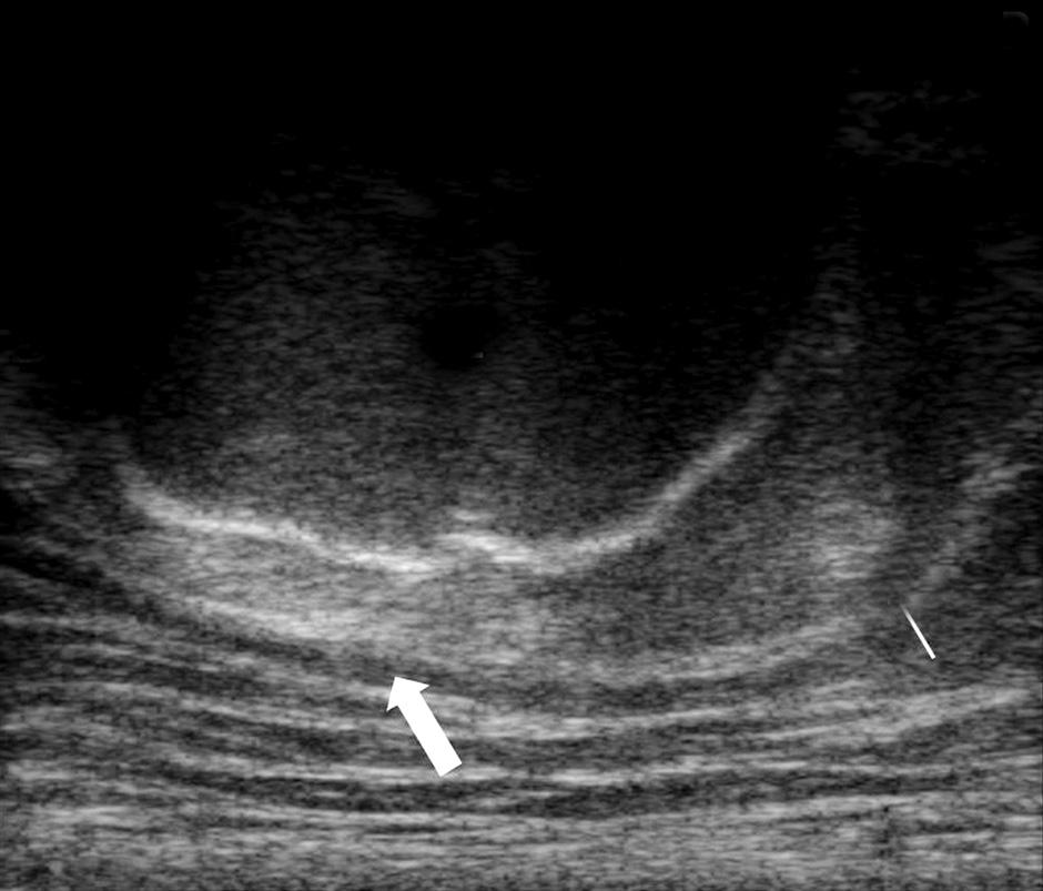 Posterior hip ultrasonography. (A) Convex transducer can be useful for posterior examination. (B) Transverse scan around the IT.