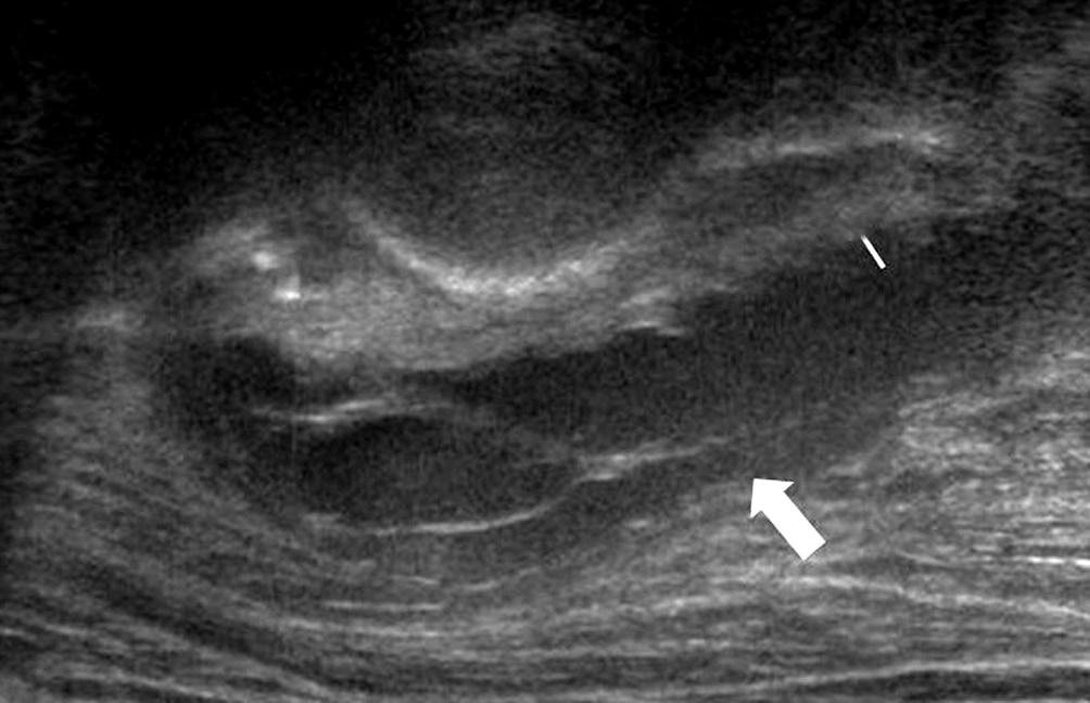 IT, ischial tuberosity. 에위치한내전근, 이상근, 외회전근등은여전히관찰이힘들며 주로좌골조면 (ischial tuberosity) 에서기시하는대퇴근육에대한 검사나좌골점액낭을확인하기위해사용하는경우가많다.