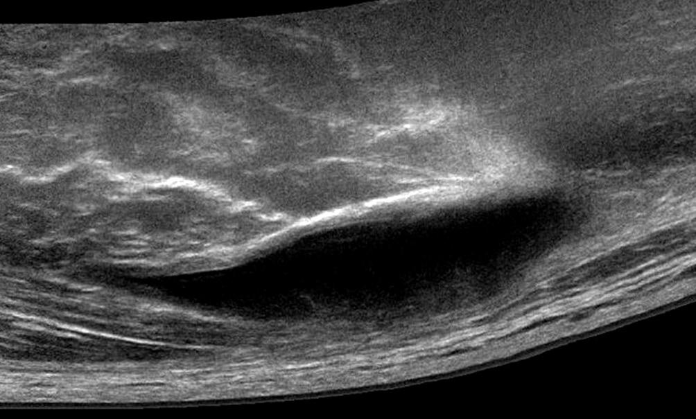 481 linical Usage of Ultrasonography for the Hip Joint 용할수있다. 좌둔점액낭염이의심되나슬굴곡근을따라방사 통이있어추간판탈출증과감별이필요한경우초음파로낭성 병변을찾아도움을받을수있다 (Fig. 12). 7.