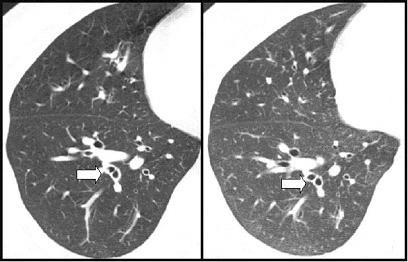 bronchi in the right middle and lower lung zones, with mild hyperinflation.