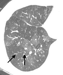JS Park et al. : Radiologic findings of bronchial asthma Figure 4. Bronchial dilatation in patients with bronchial asthma.