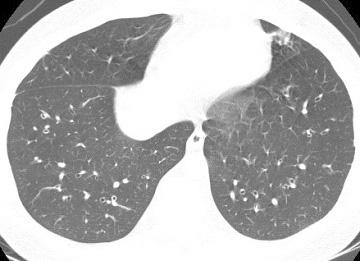 bronchiectasis. Figure 5. Air trapping in patient with bronchial asthma.