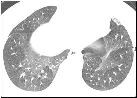 HRCT scan obtained at same level shows geographic air trapping in both basal lungs during full expiration. MEFR과통계학적으로유의한상관관계를보였다 29.