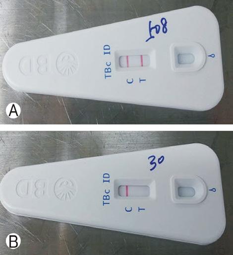 MGIT and ICA to Detect M. Tuberculosis Fig. 1. Identification of the M. tuberculosis complex by the TB Ag MPT64 immunochromatic assay (ICA) kit. (A) positive two band indicating M.