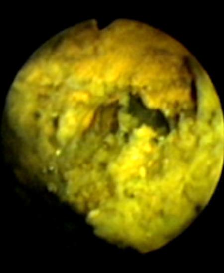 담석의 내시경 치료 유병무 Figure 3. Peroral cholangioscopic extrahepatic bile duct stone removal. (A) Huge extrahepatic bile duct stone was seen at common hepatic duct level.
