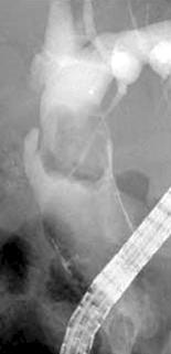 (C) Radiograph showing EHL under direct POC (the tip of the EHL probe is indicated by the arrow). (D) Cholangioscopic view showing CBD stone fragmentation with EHL.