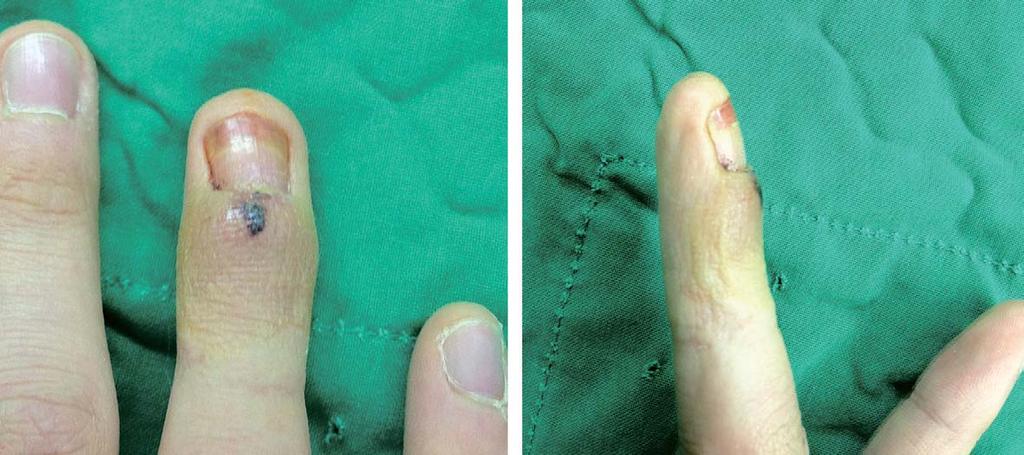 Dae Hee Lee, et al. Growth Disturbance of Nail Plate after a Metacarpal Fracture - Four Cases Report - Fig. 2.