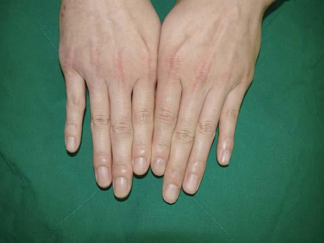 Right fingers showing the swelling of eponychium, compared with that of left fingers. 막의부종이호전된것을확인할수있었다 (Fig. 1F). 2. 증례 2 14세남자로 3주전부터지속된우측 4 수지손톱주위동통및분비물을주소로내원하였다.