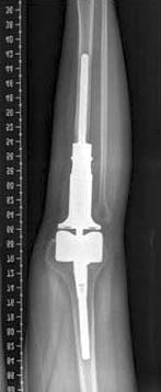 (A) Osteosarcoma of the proximal tibia.