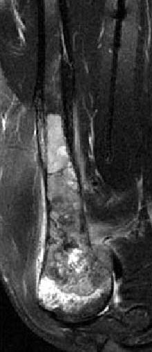 (A) A typical image of the proximal humeral osteosarcoma.