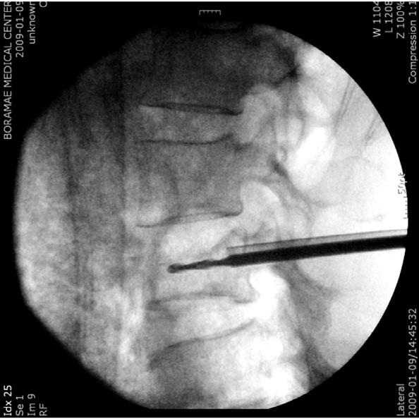 Minimally Invasive Treatment of Painful Osteoporotic Vertebral Fractures Figure 3.