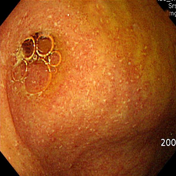 경우에는 궤양성 대장염, 장결 핵, 베체트 장염과 감별해야 한다. 초기 소견은 국소 점상발적이며 이후 아프타 궤양(aphthous ulcer)으로 진행된다.