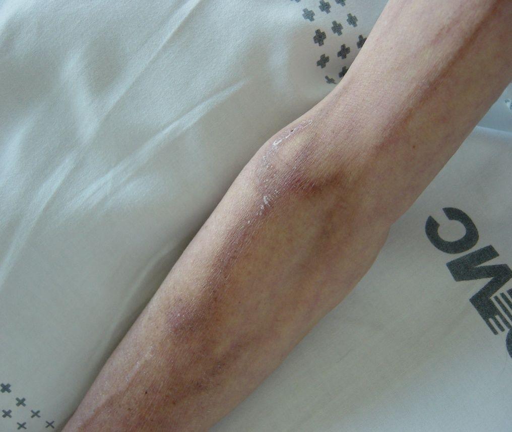 Irritant Drugs Pain at the injection site or along the vein, with or without an inflammatory reaction