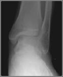 talus Pain, swelling,