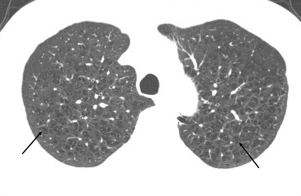 The Korean Journal of Medicine: Vol. 77, No. 4, 2009 B A Figure 1. In patients with emphysema, areas of abnormally low attenuation are shown without visible walls on CT scans.
