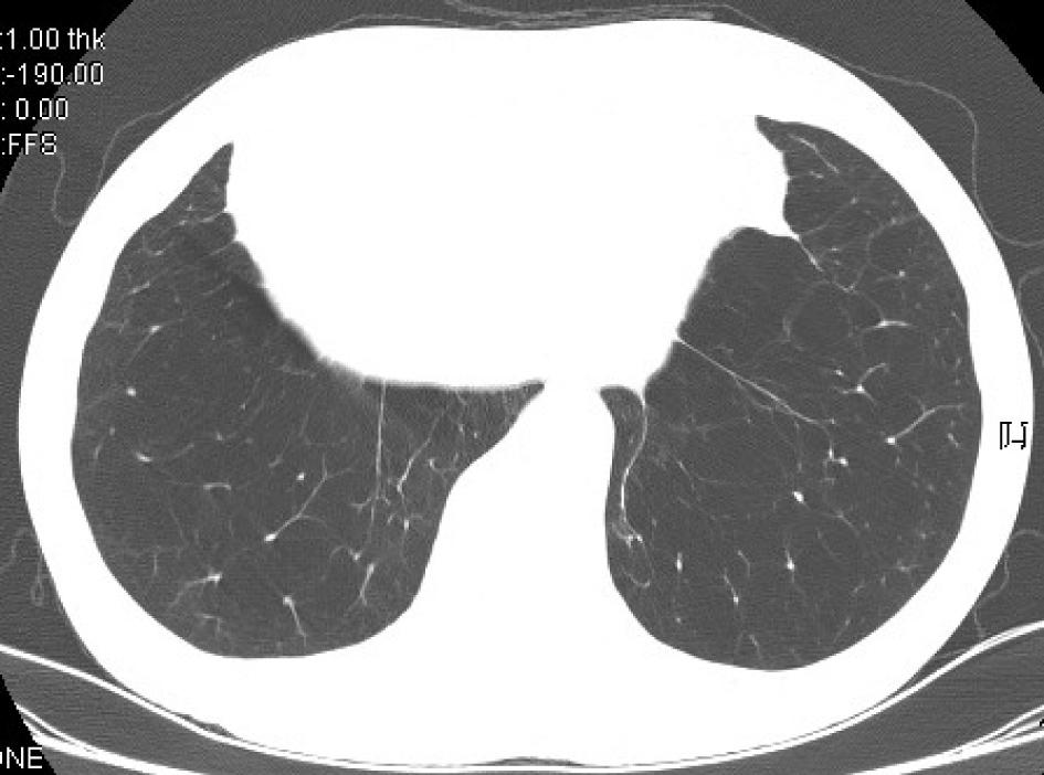In patients with panlobular emphysema (B), CT shows confluent areas of homogenous lower attenuation that involve lower lung zones more severely.