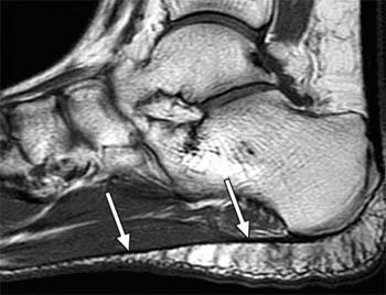 T1-weighted sagittal image in a patient without heel pain.