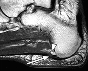 T1-weighted sagittal image in a 50 year old female with mild, chronic heel pain reveals thickening and increased signal