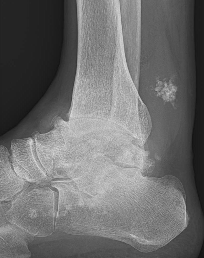 X ray asymmetric cartilage