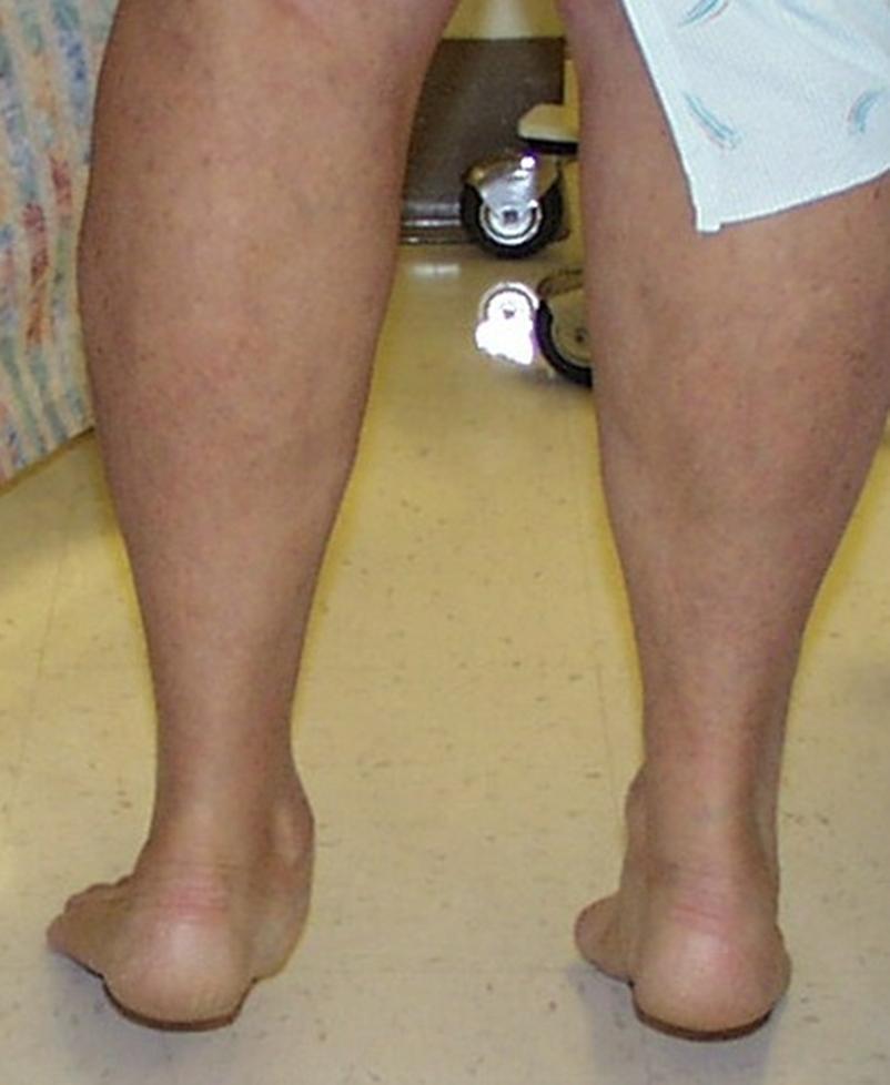 Stage 2 controlling longitudinal arch and heel valgus Foot orthosis AFO, Supramalleolar