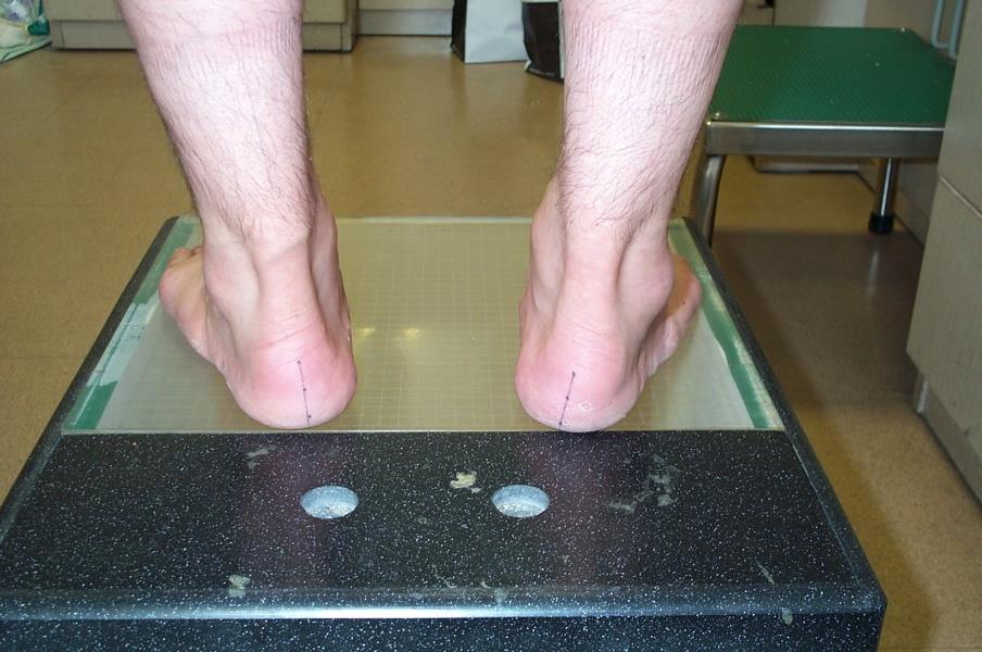Case 3 M/35, 체중 70kg Dx: peroneal tendinitis Associated problems: high arch foot, callus on 5 th MT head and lateral heel