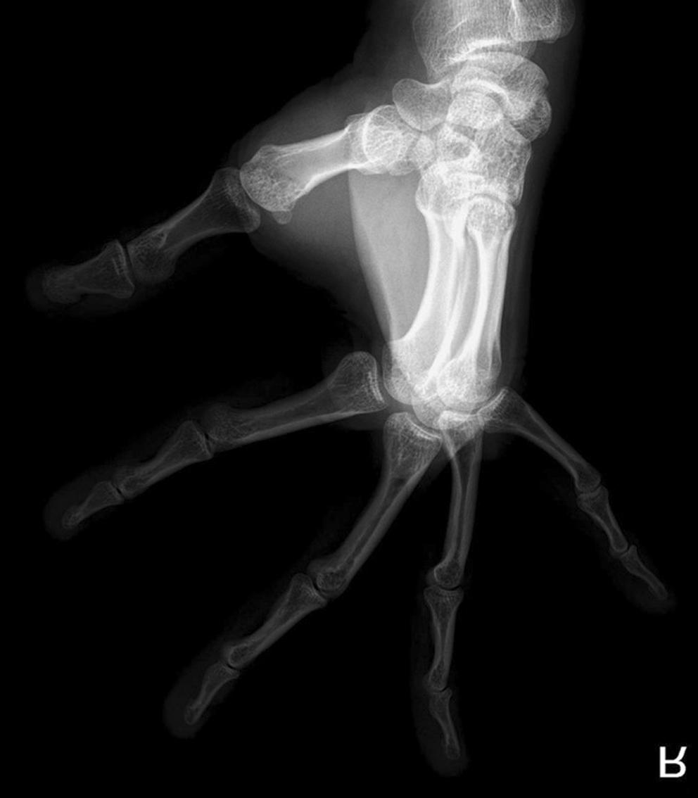 Journal of the Korean Fracture Society Vol. 31, No. 2, pril 2018 있으며, 이차적인 손상을 찾거나 병적 골절을 진단할 수 있다. 하여 얻을 수 있는데 척측 수근중수관절의 골절, 탈구 등 다 예를 들어 작은 충격으로 인해 골절이 되었다면 골다공증 혹 른 사진에서 명확하지 않은 손상도 확인할 수 있다.