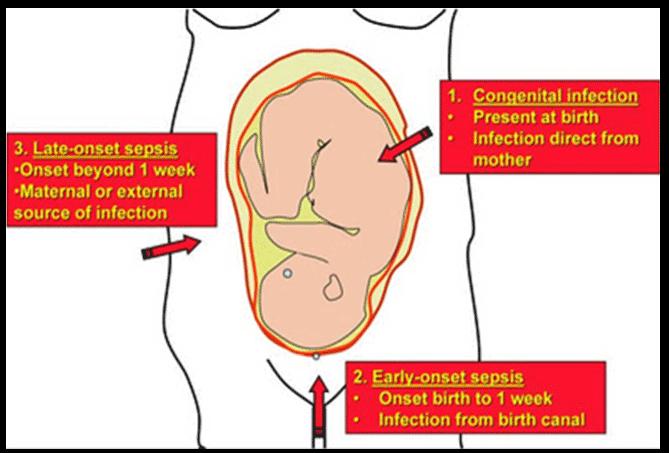 3. 역학 - 10~30% 의산모에서 vaginal, rectal colonization à 신생아중 50% 가량에서 colonization à 1~2%