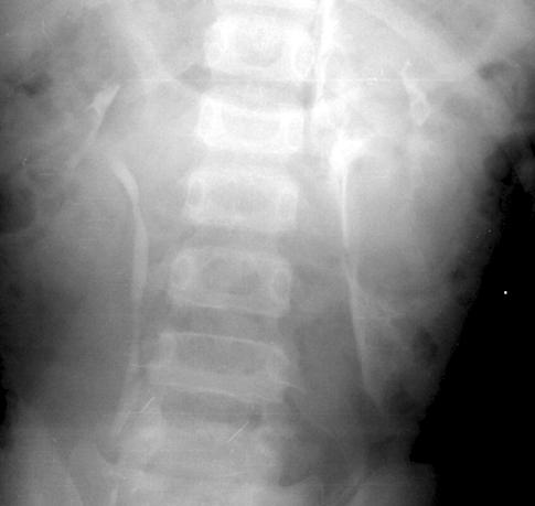 4-year-old child whose conservative treatment was failed.