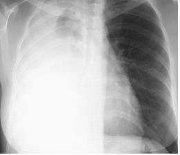 JO Na, et al.: A Case of Epithelioid Hemangioendothelioma in lung, pleura, liver 가족력 : 특이사항없음진찰소견 : 혈압 110/70 mmhg, 맥박수 110 회 / 분, 호흡수 22 회 / 분, 체온 36.5 이었다.