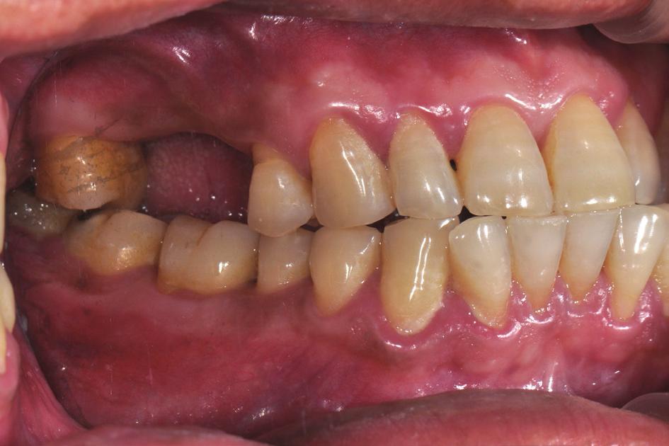 0 mm의 OneQ (Dentis, 첫 번째 증례는 50세의 남자 환자로 상악 구치부 치아 Daegu, Korea)를 사용하였다. 임플란트 식립 후 치근단 수복을 주소로 내원하였다(Fig. 1-3). #15, 16 부위에 방사선 사진을 촬영하여 계획된 위치와 비교하였다(Fig. 임플란트 지지 고정성 보철물로 치료 계획 후 컴퓨터 단 11).