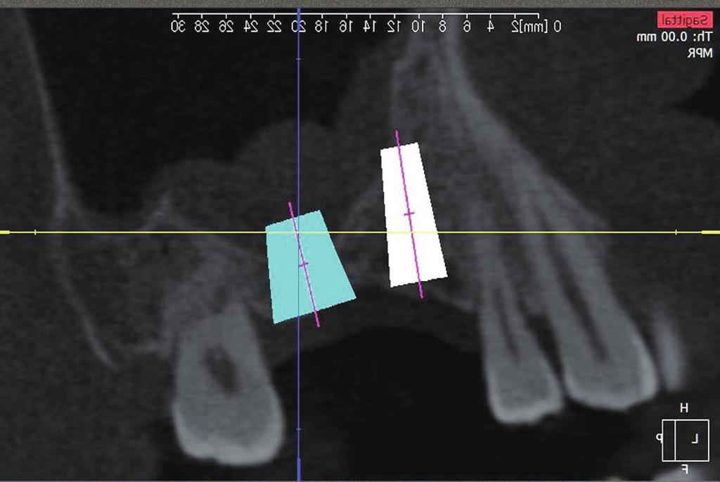 Implant placement using a newly