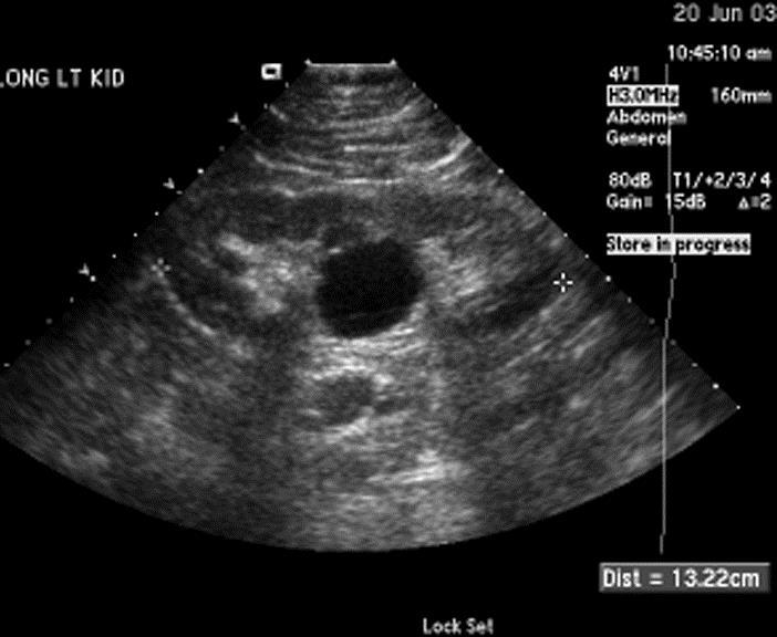 Parapelvic cyst( 신우주위낭종 ) 신문 renal hilum