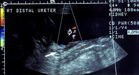 Ureteral calculi ureteric jet