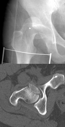Result of Surgical Treatment for the Femoral Head Fracture 201 Fig. 1.