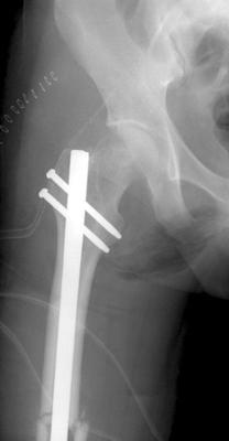 fracture and internal fixation for femoral shaft fracture.