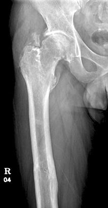 osteoarthritis and avascular necrosis of the femoral head.