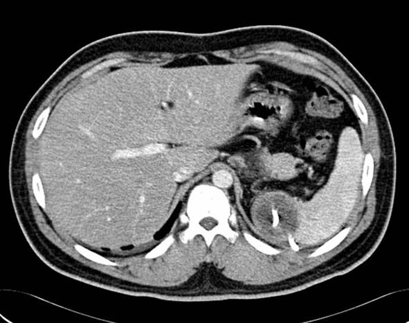 Figure 3. (, ) Eight months later, abdominal CT showed progression of the now 5 8.