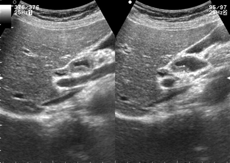 전창균외 3 인 30 Fig. 1. (A) Wall thickening of proximal CBD was noted on abdominal ultrasonography.