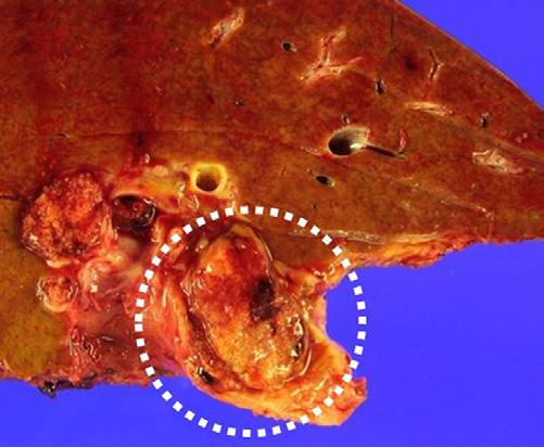 Endoscopic retrograde cholangiopancreatography: Biopsy was performed on intraductal hard mass in