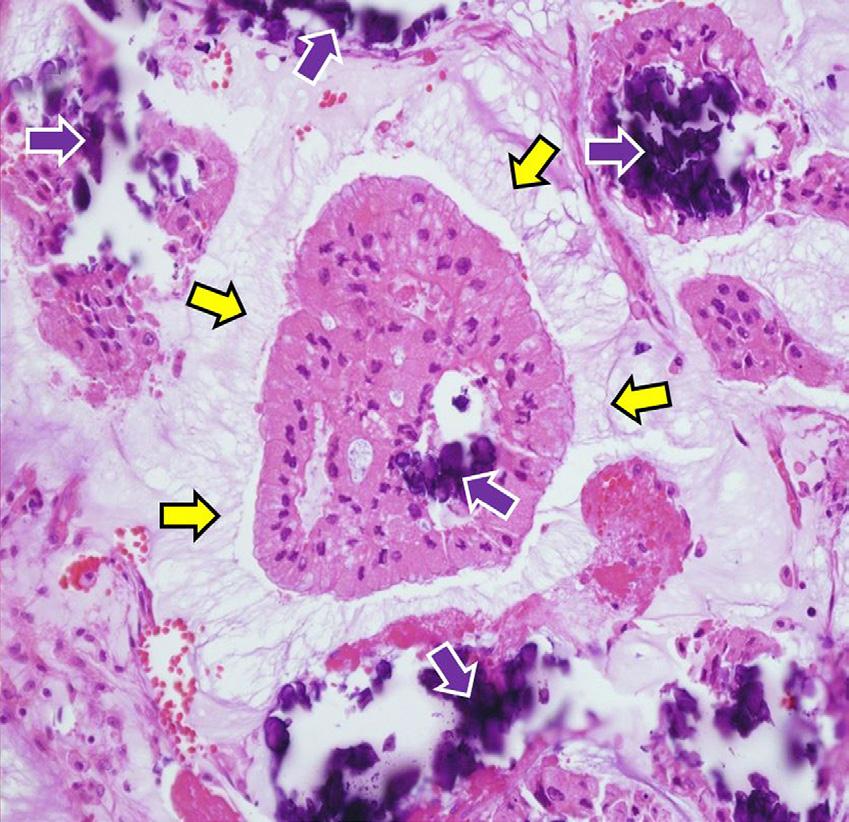 The main mass was spreaded into the second branch (wihite arrow) of right hepatic duct (B).